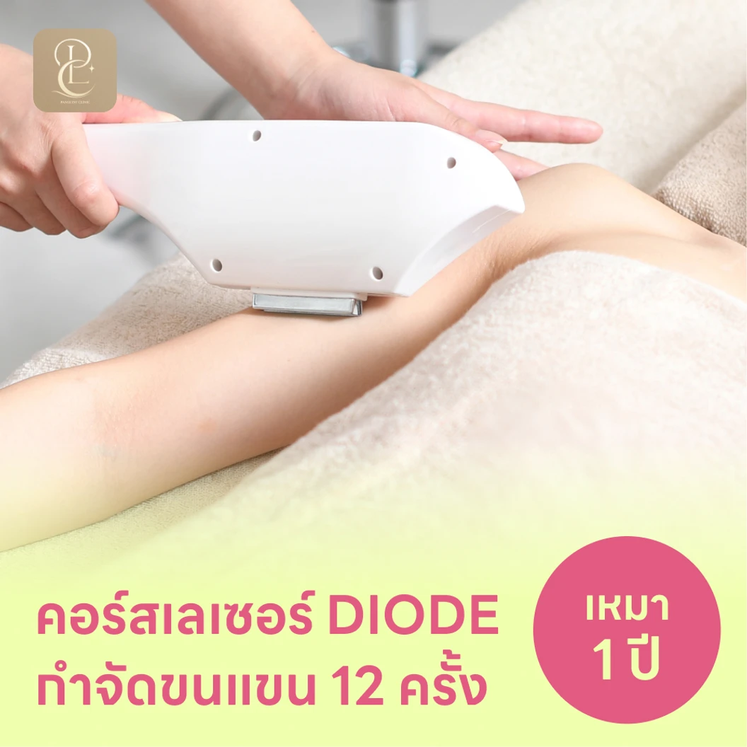 คอร์สเลเซอร์กำจัดขนทั่วแขน 12 ครั้ง ด้วย Diode Laser