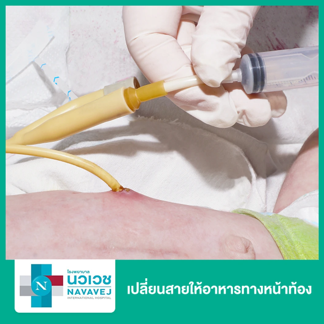 เปลี่ยนสายให้อาหารทางหน้าท้อง