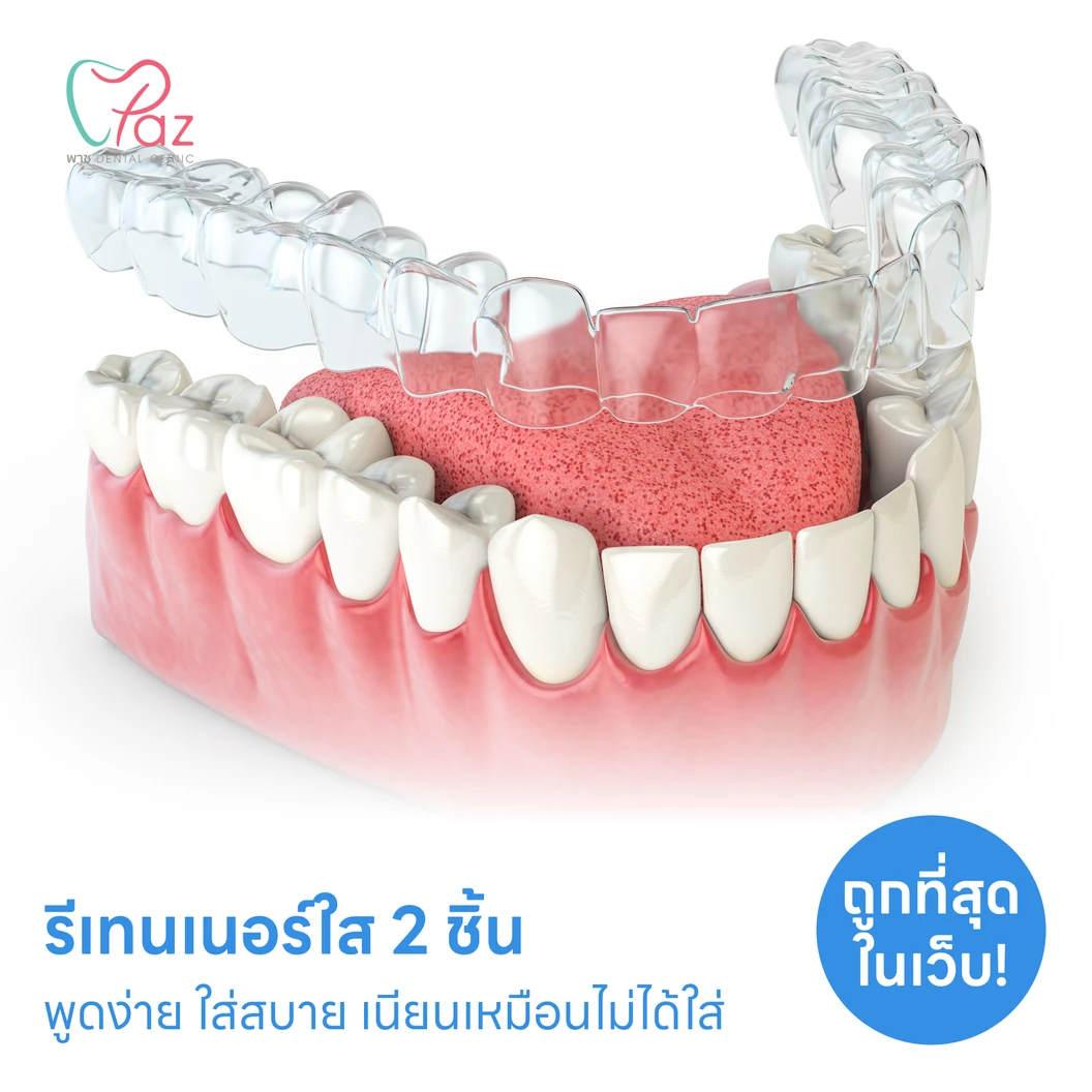 ทำรีเทนเนอร์แบบใส 2 ชิ้น