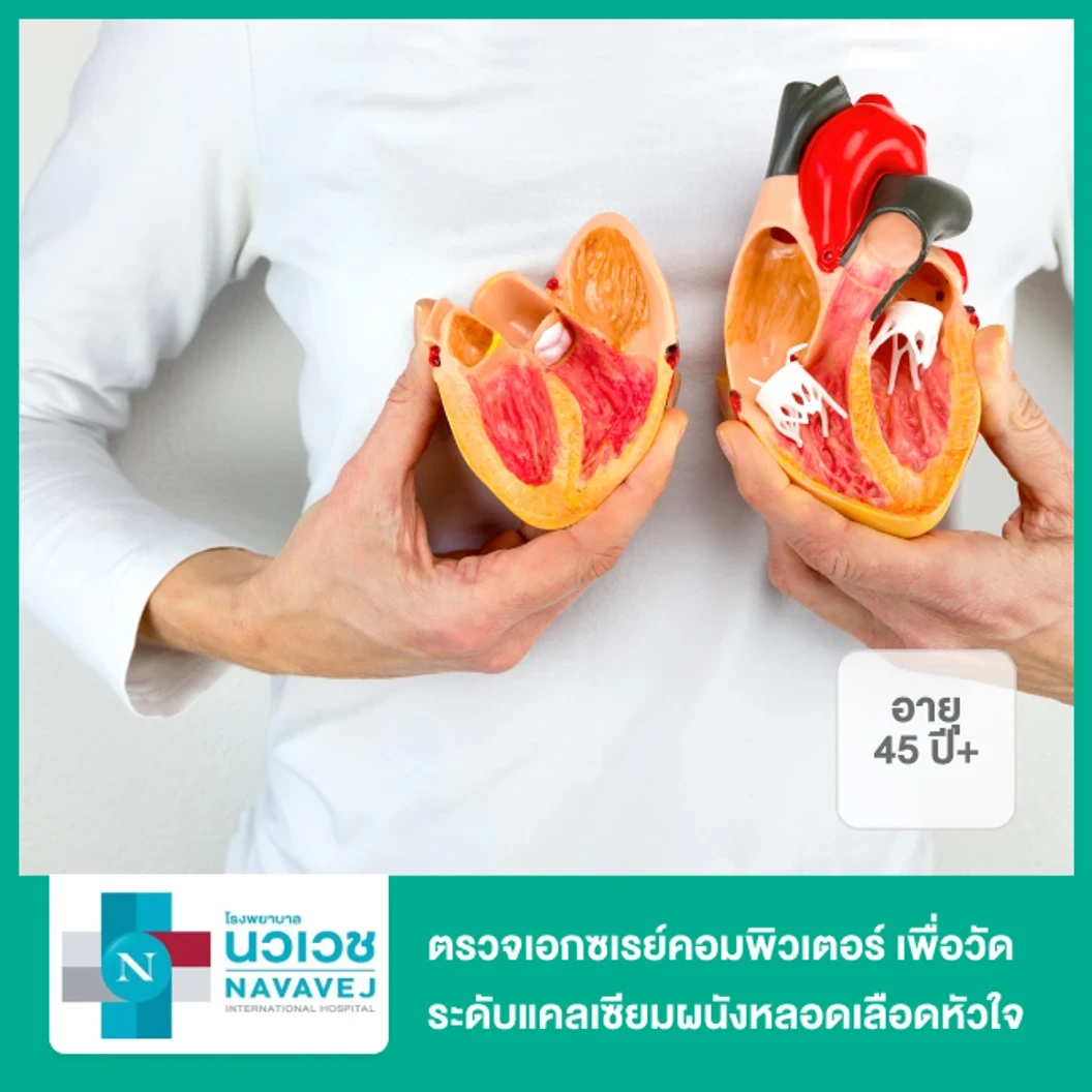 ตรวจเอกซเรย์คอมพิวเตอร์ เพื่อวัดระดับแคลเซียมผนังหลอดเลือดหัวใจ (CT Calcium Score) สำหรับผู้ที่อายุ 45 ปีขึ้นไป