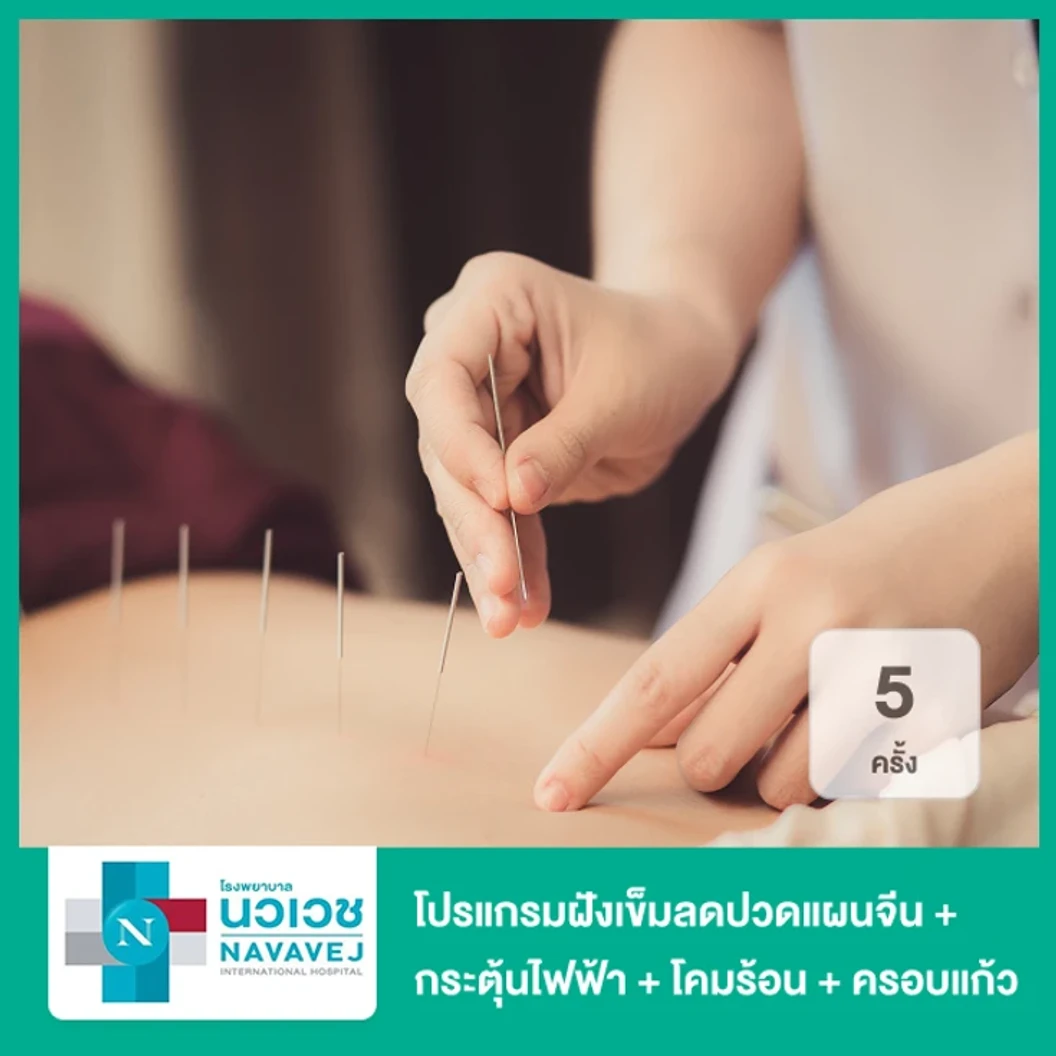 โปรแกรมฝังเข็มลดปวดแผนจีน + กระตุ้นไฟฟ้า + โคมร้อน + ครอบแก้ว 5 ครั้ง