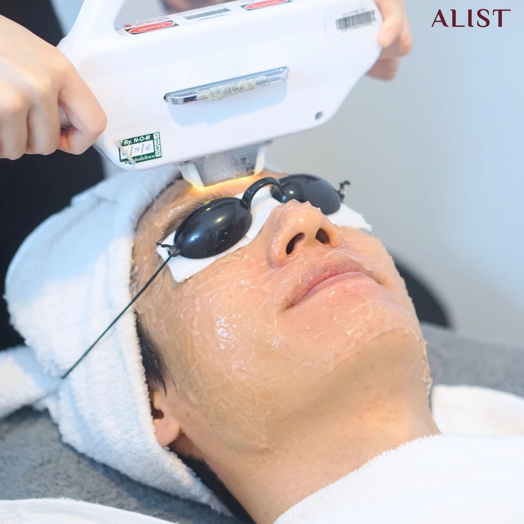 โปรแกรมลดรอยสิวหน้า (E-Light Program) 6 ขั้นตอน