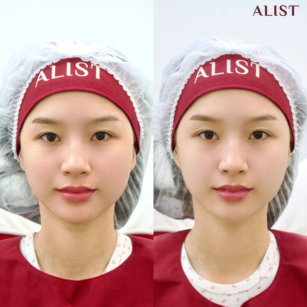 โปรแกรม Ultra Lift 100 ช็อต (หน้า)