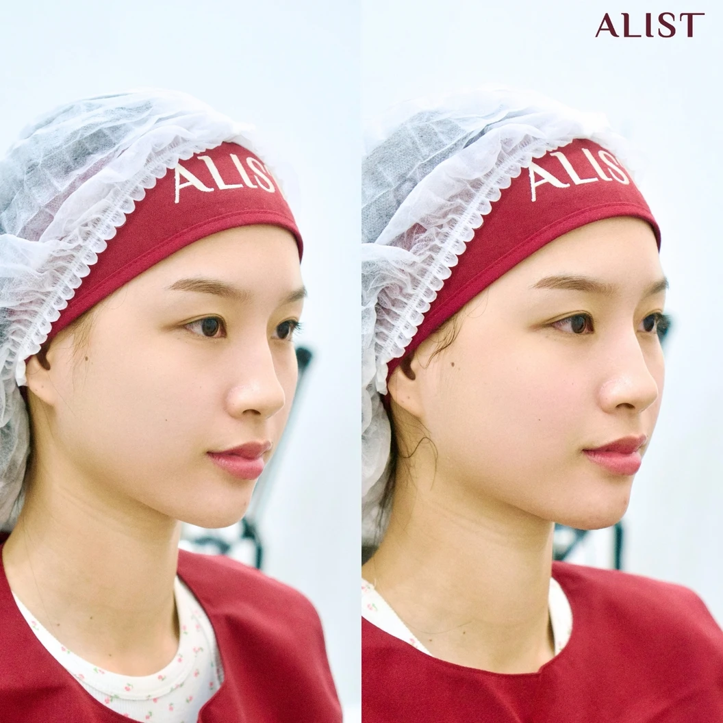 โปรแกรม Ultra Lift 100 ช็อต (หน้า)