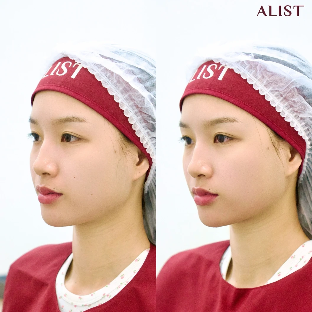 โปรแกรม Ultra Lift 100 ช็อต (หน้า)