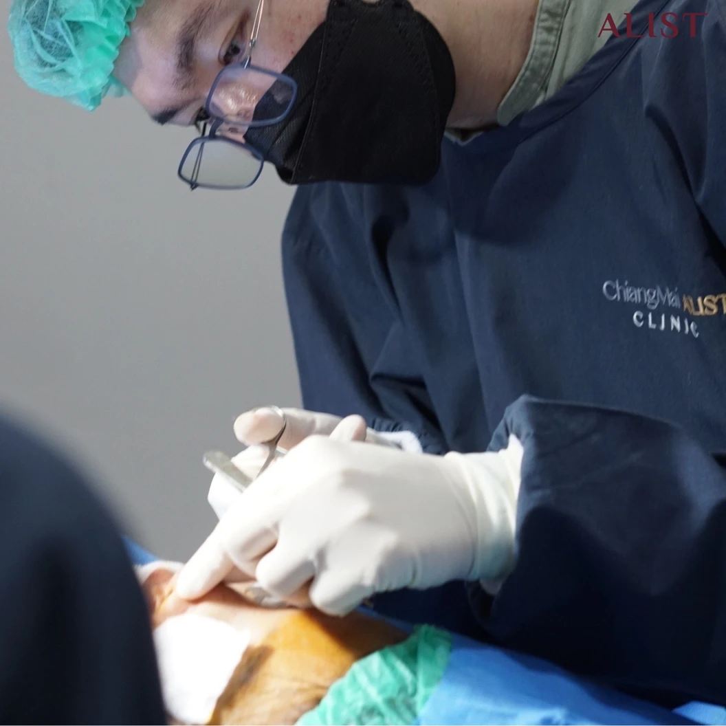 โปรแกรมถอดซิลิโคนบริเวณจมูก