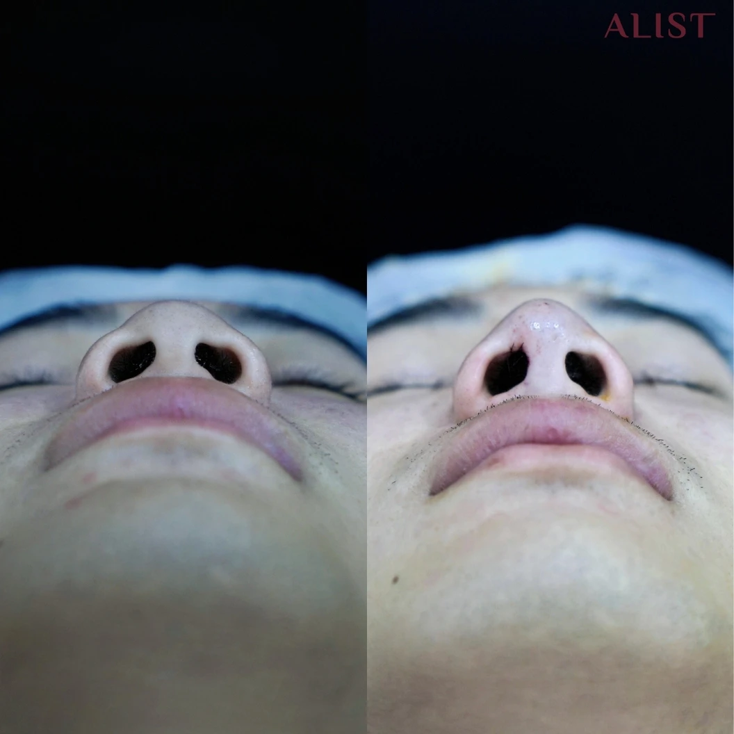 เสริมจมูก ด้วยซิลิโคนอเมริกา เทคนิค A-List Triple Lock (เคสแก้)