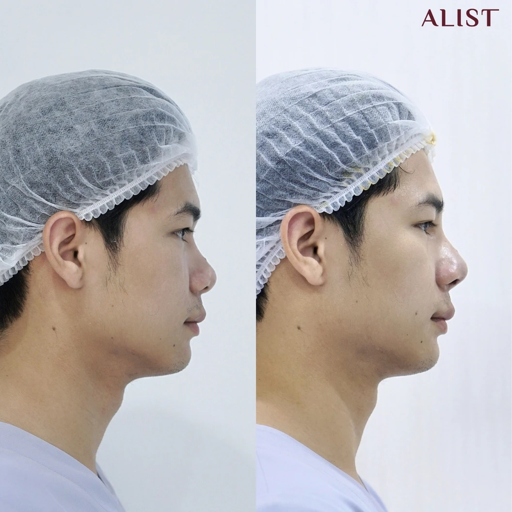 เสริมจมูก ด้วยซิลิโคนอเมริกา เทคนิค A-List Triple Lock (เคสแก้)