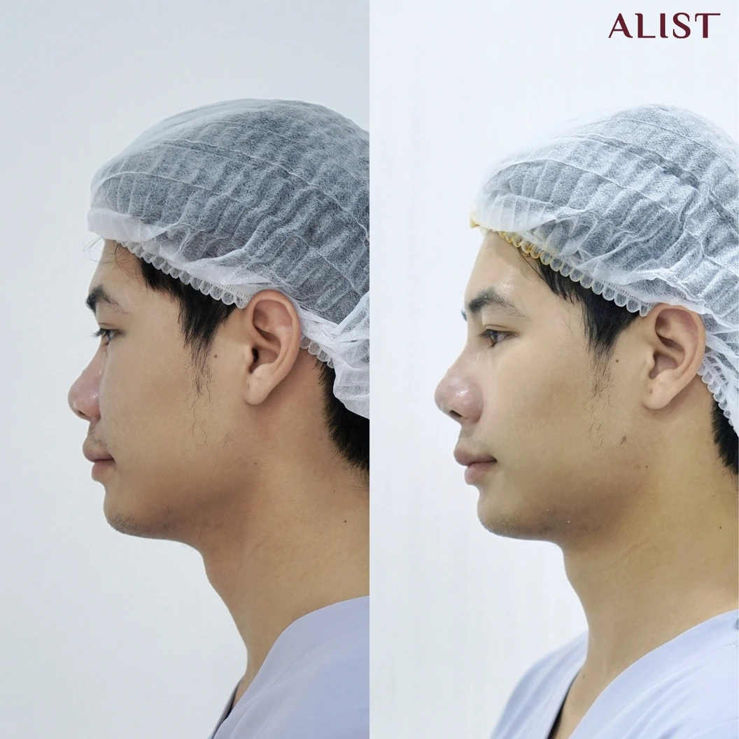 เสริมจมูก ด้วยซิลิโคนอเมริกา เทคนิค A-List Triple Lock (เคสแก้)