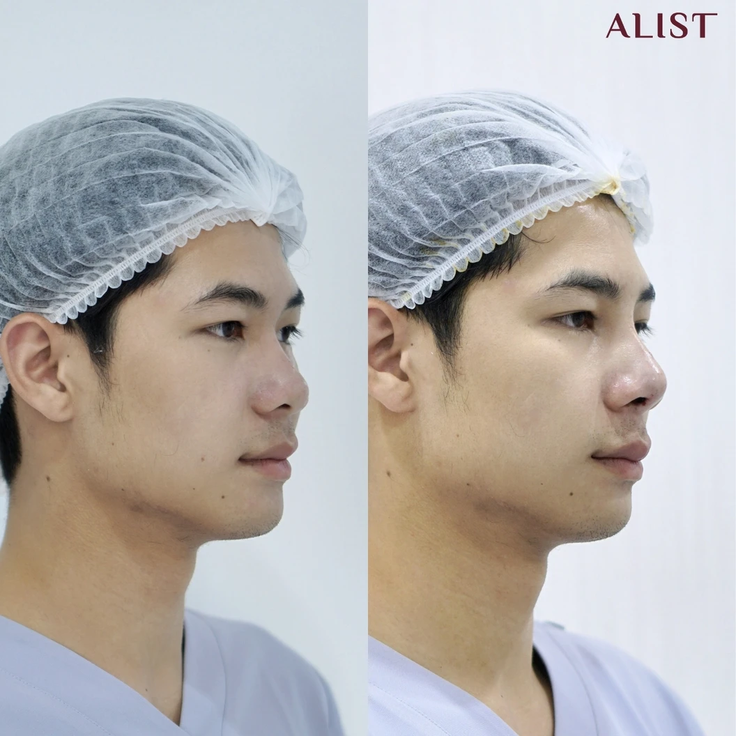 เสริมจมูก ด้วยซิลิโคนอเมริกา เทคนิค A-List Triple Lock (เคสแก้)