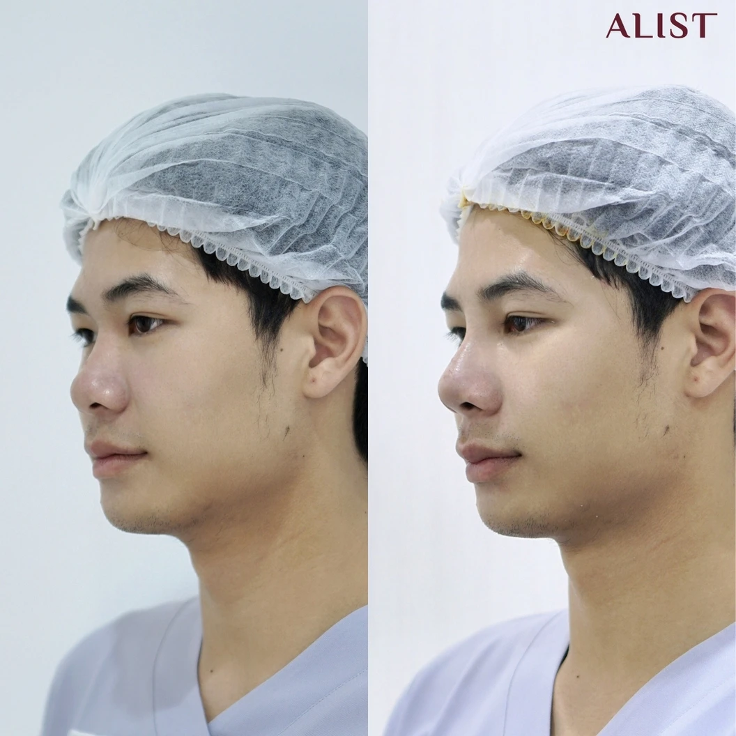 เสริมจมูก ด้วยซิลิโคนอเมริกา เทคนิค A-List Triple Lock (เคสแก้)