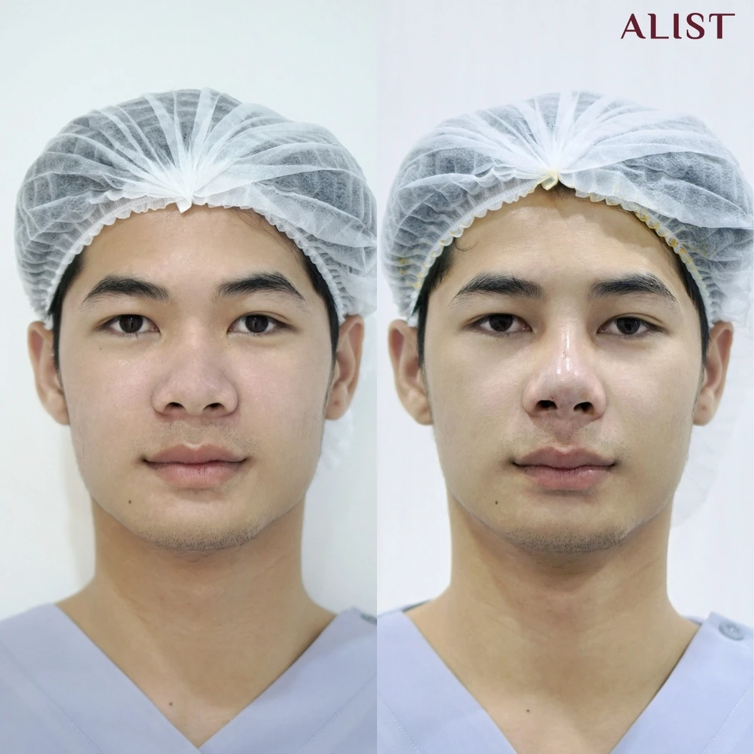 เสริมจมูก ด้วยซิลิโคนอเมริกา เทคนิค A-List Triple Lock (เคสแก้)