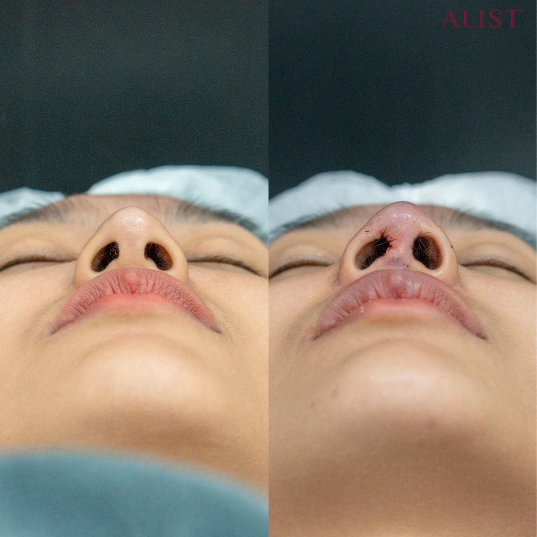 เสริมจมูก ด้วยซิลิโคนอเมริกา เทคนิค A-List Triple Lock (เคสแก้)