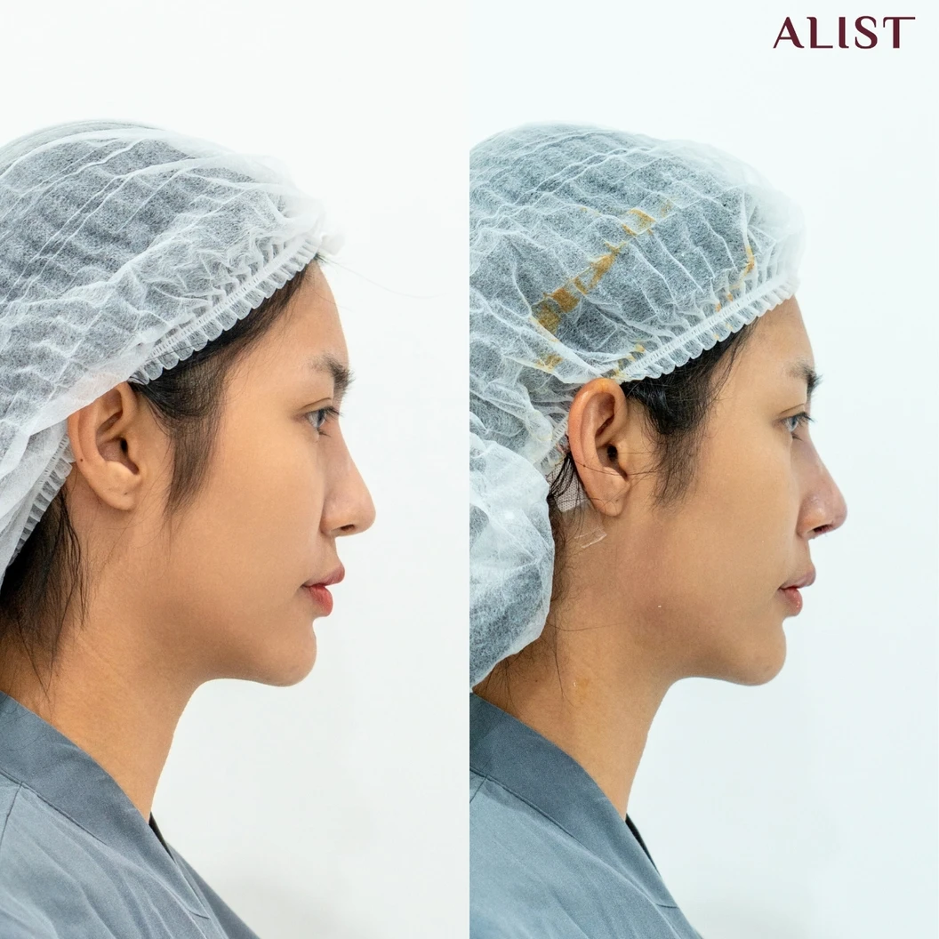 เสริมจมูก ด้วยซิลิโคนอเมริกา เทคนิค A-List Triple Lock (เคสแก้)