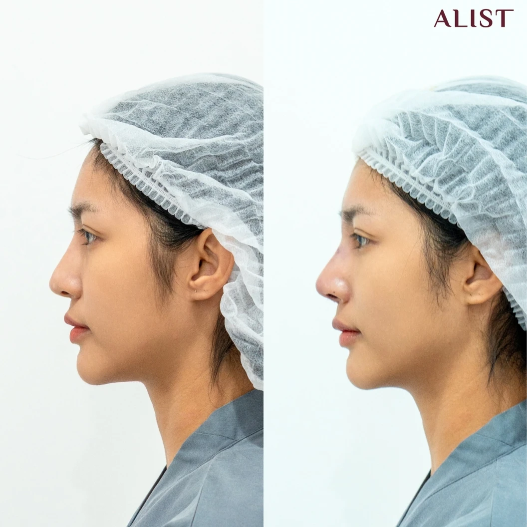 เสริมจมูก ด้วยซิลิโคนอเมริกา เทคนิค A-List Triple Lock (เคสแก้)