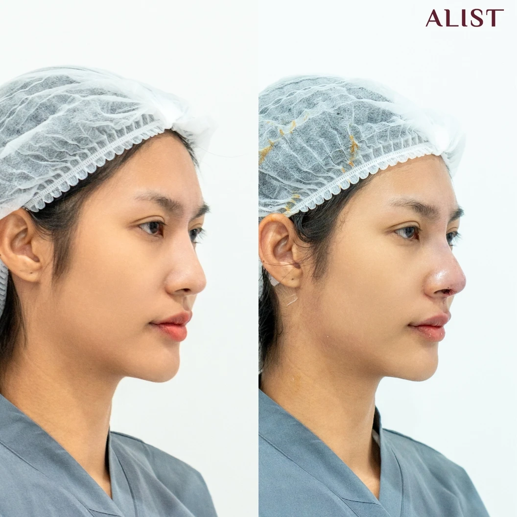 เสริมจมูก ด้วยซิลิโคนอเมริกา เทคนิค A-List Triple Lock (เคสแก้)