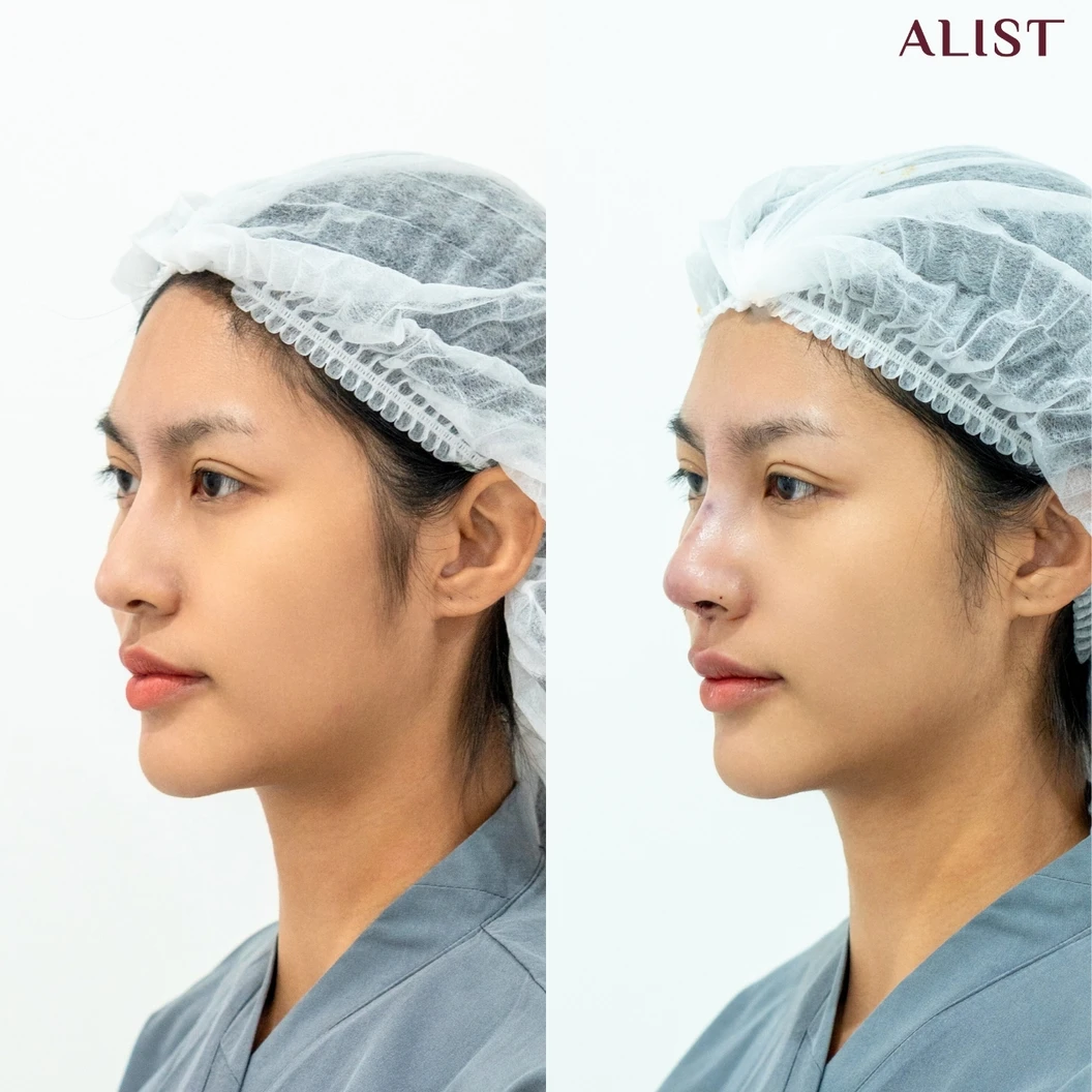 เสริมจมูก ด้วยซิลิโคนอเมริกา เทคนิค A-List Triple Lock (เคสแก้)