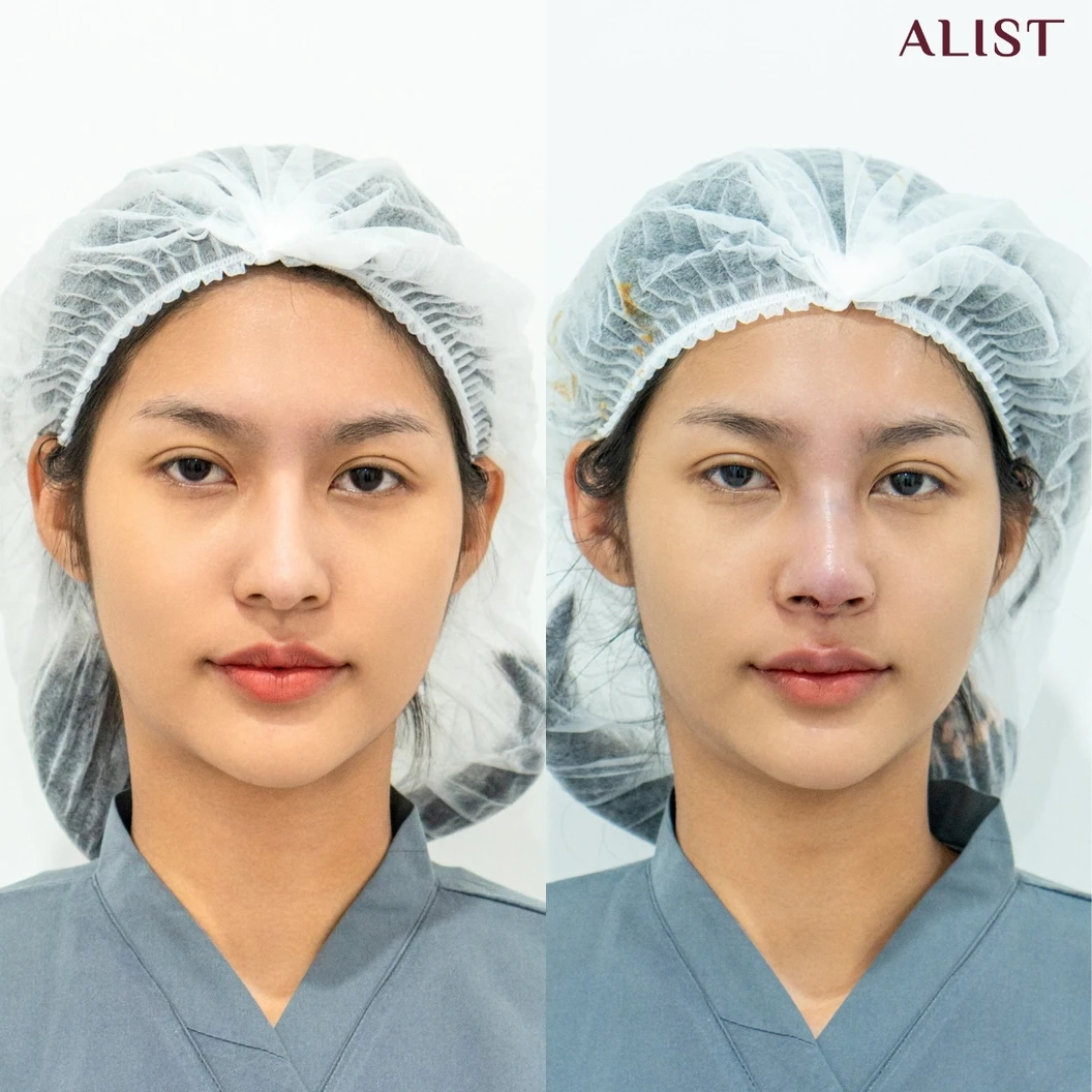 เสริมจมูก ด้วยซิลิโคนอเมริกา เทคนิค A-List Triple Lock (เคสแก้)