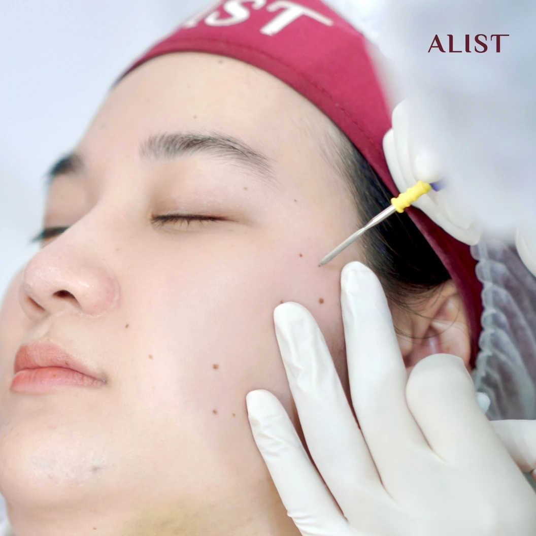 โปรแกรมกำจัดไฝ ขี้แมลงวัน (ALIST Mole Removal) ด้วย Electrosurgical Cautery 25 จุด (ทั่วหน้า)