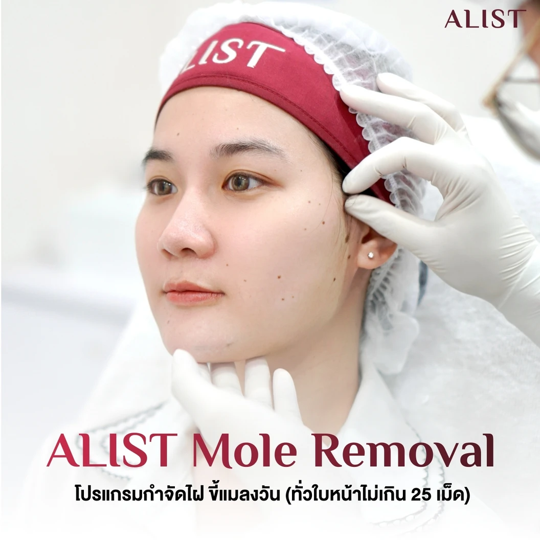 โปรแกรมกำจัดไฝ ขี้แมลงวัน (ALIST Mole Removal) ด้วย Electrosurgical Cautery 25 จุด (ทั่วหน้า)