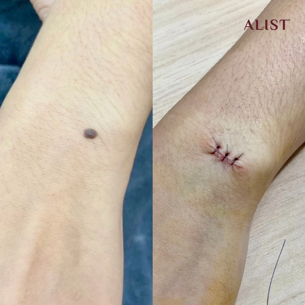 โปรแกรมผ่าไฝ ขี้แมลงวัน (ALIST Nevus Surgery) 1 จุด ขนาด 5 มม. ขึ้นไป