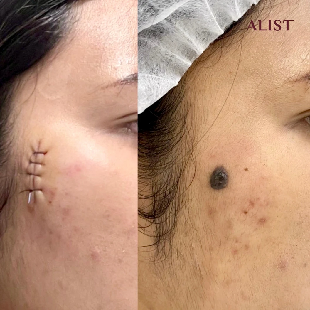 โปรแกรมผ่าไฝ ขี้แมลงวัน (ALIST Nevus Surgery) 1 จุด ขนาด 5 มม. ขึ้นไป