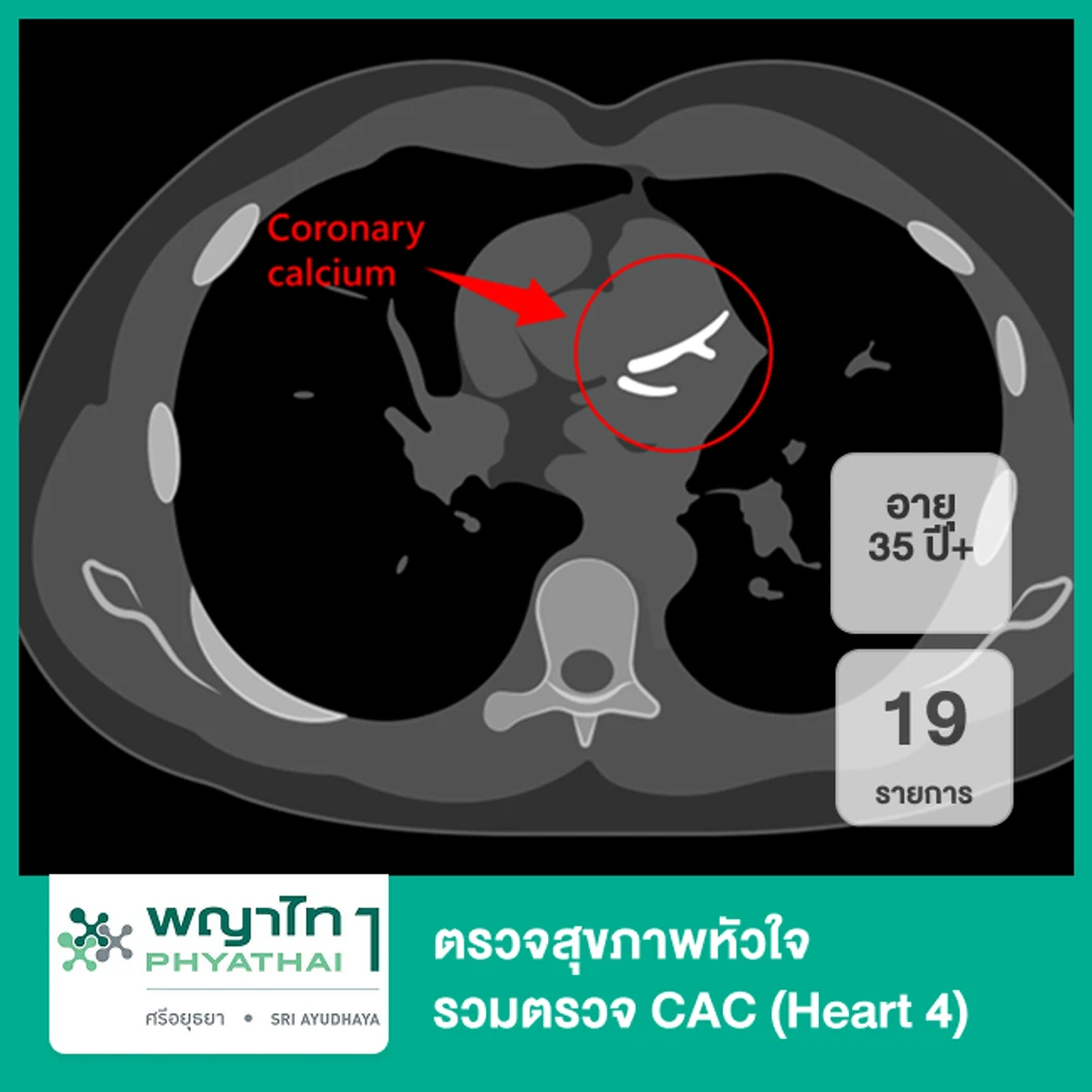 ตรวจสุขภาพหัวใจ 19 รายการ รวมตรวจ CAC (Heart 4) (35 ปีขึ้นไป)