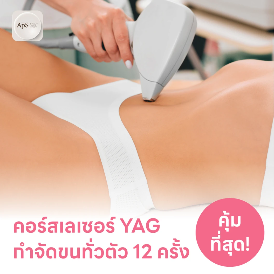 คอร์สเลเซอร์กำจัดขนเหมาทั่วตัว 12 ครั้ง ด้วย YAG Laser