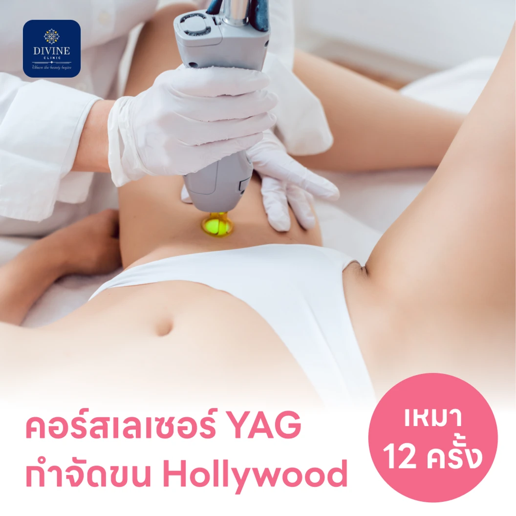 คอร์สเลเซอร์กำจัดขนน้องสาวแบบ Hollywood (vVIO) 12 ครั้ง ด้วย YAG Laser