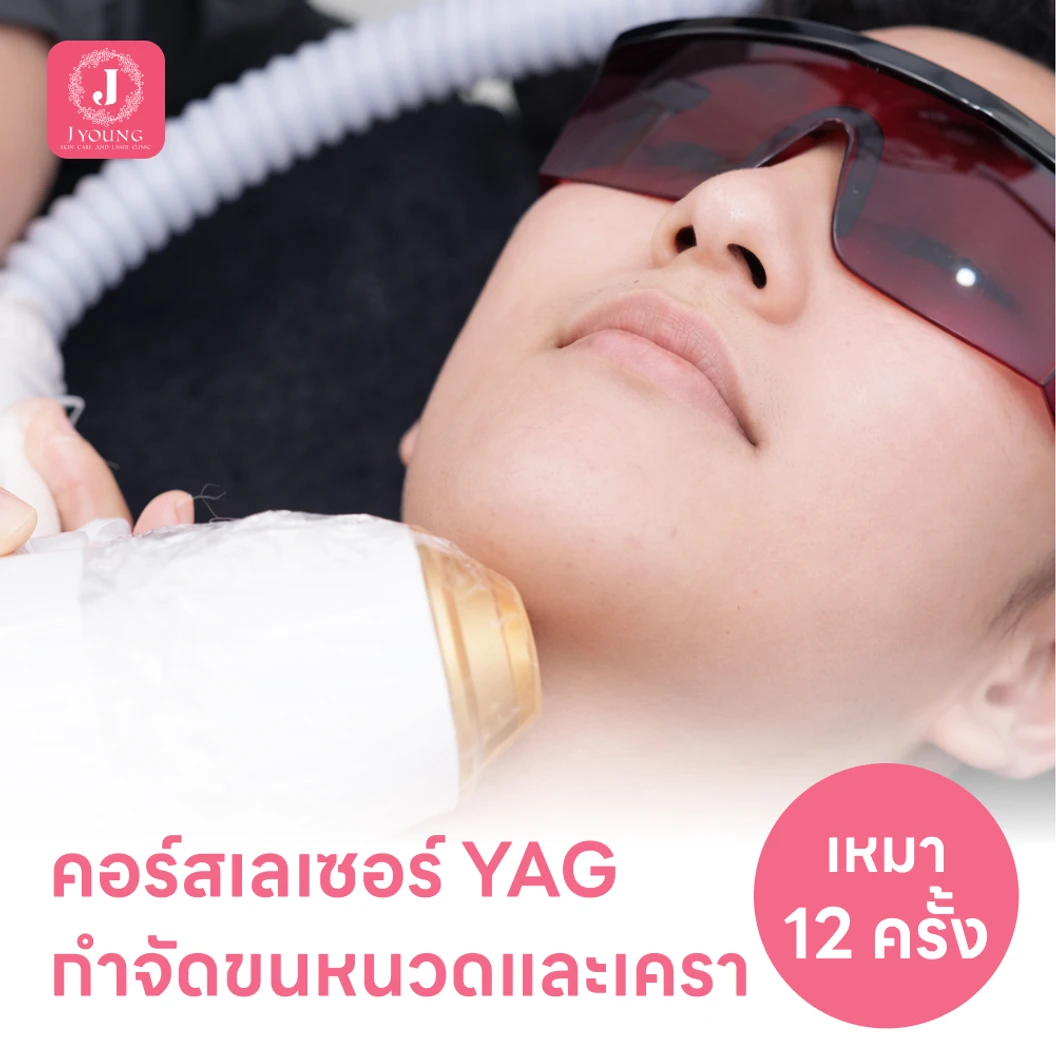 คอร์สเลเซอร์กำจัดขนหนวดและเครา 12 ครั้ง ด้วย YAG Laser