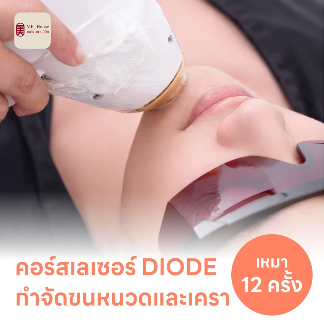 คอร์สเลเซอร์กำจัดขนหนวดและเครา 12 ครั้ง ด้วย Diode Laser