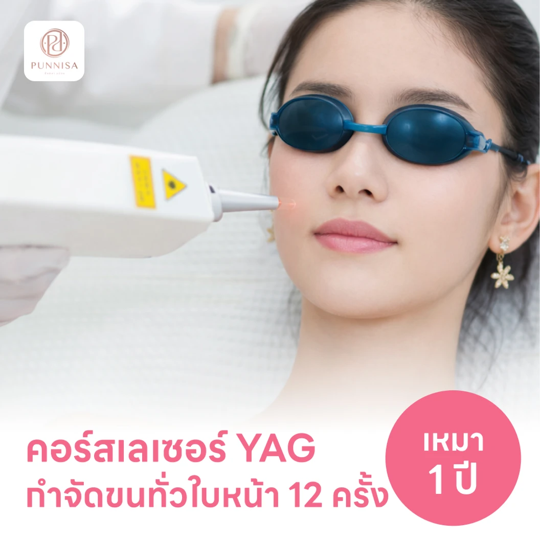 คอร์สเลเซอร์กำจัดขนทั่วหน้า 12 ครั้ง ด้วย YAG Laser