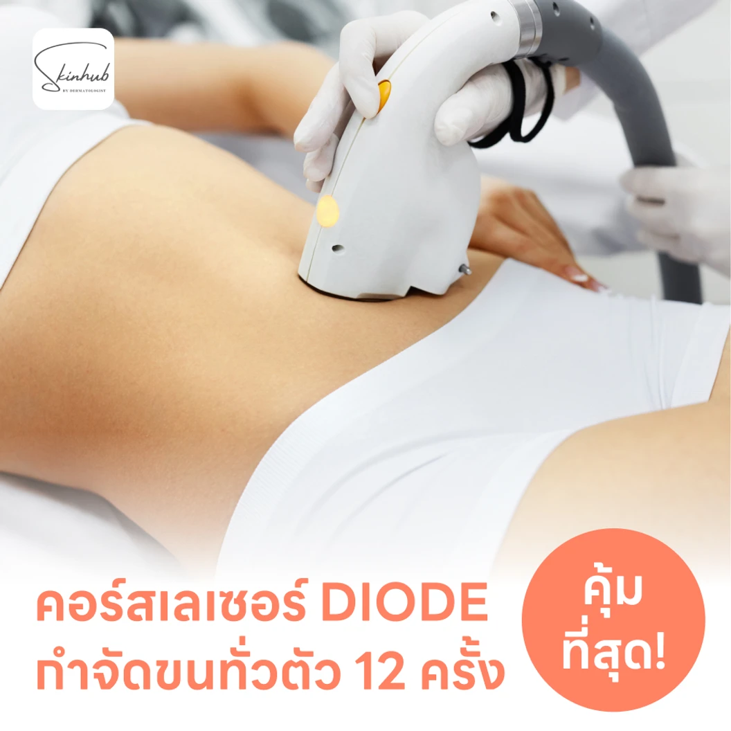 คอร์สเลเซอร์กำจัดขนทั่วร่างกาย 12 ครั้ง ด้วย Diode Laser