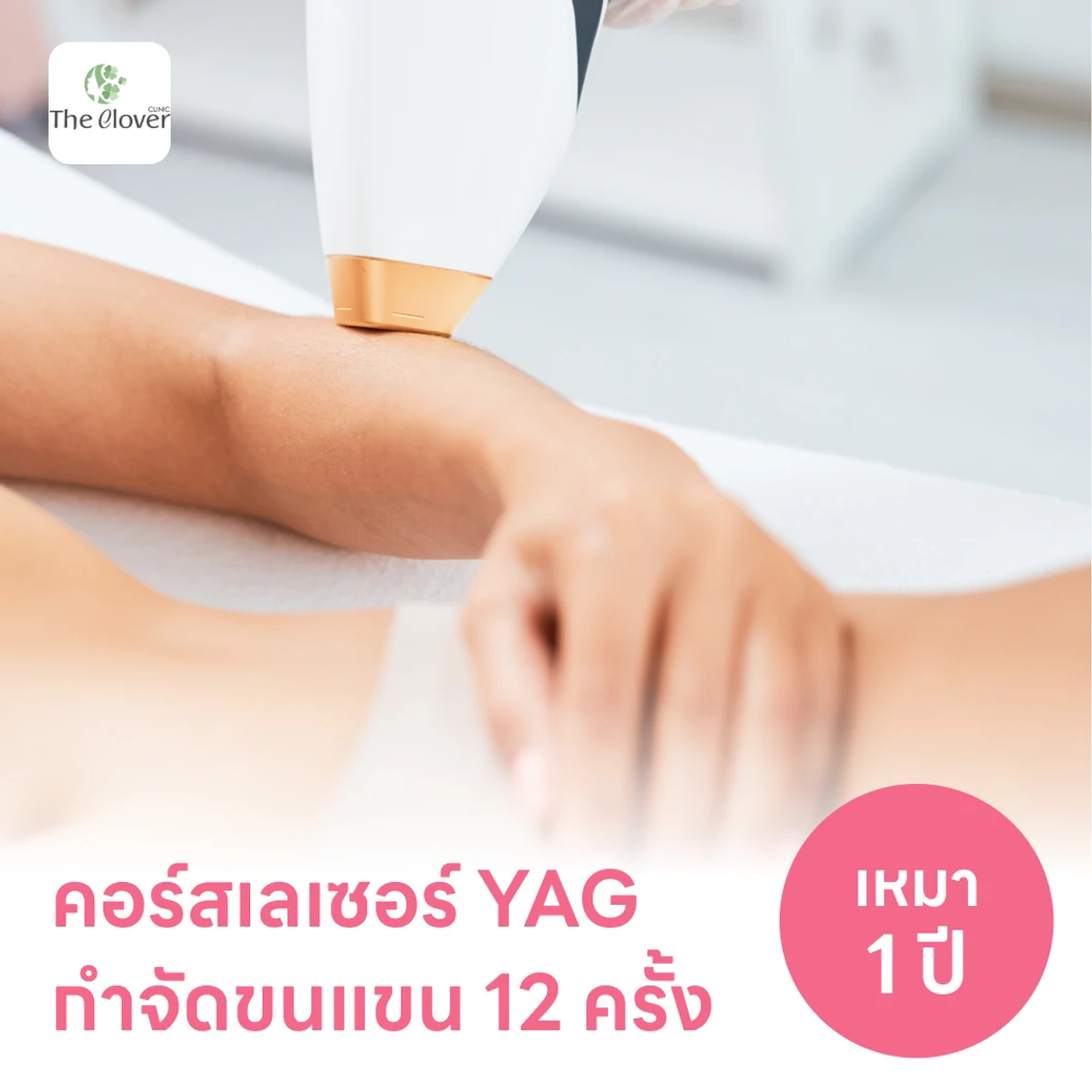คอร์สเลเซอร์กำจัดขนแขน 12 ครั้ง ด้วย YAG Laser