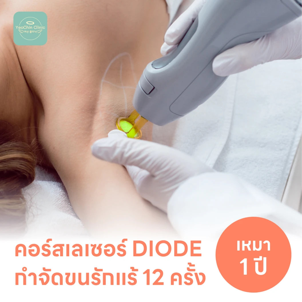 คอร์สเลเซอร์กำจัดขนรักแร้ 12 ครั้ง ด้วย Diode Laser