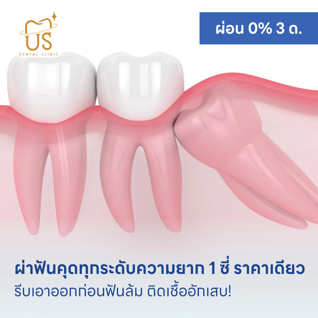 ผ่าฟันคุดทุกระดับความยาก 1 ซี่ ราคาเดียว