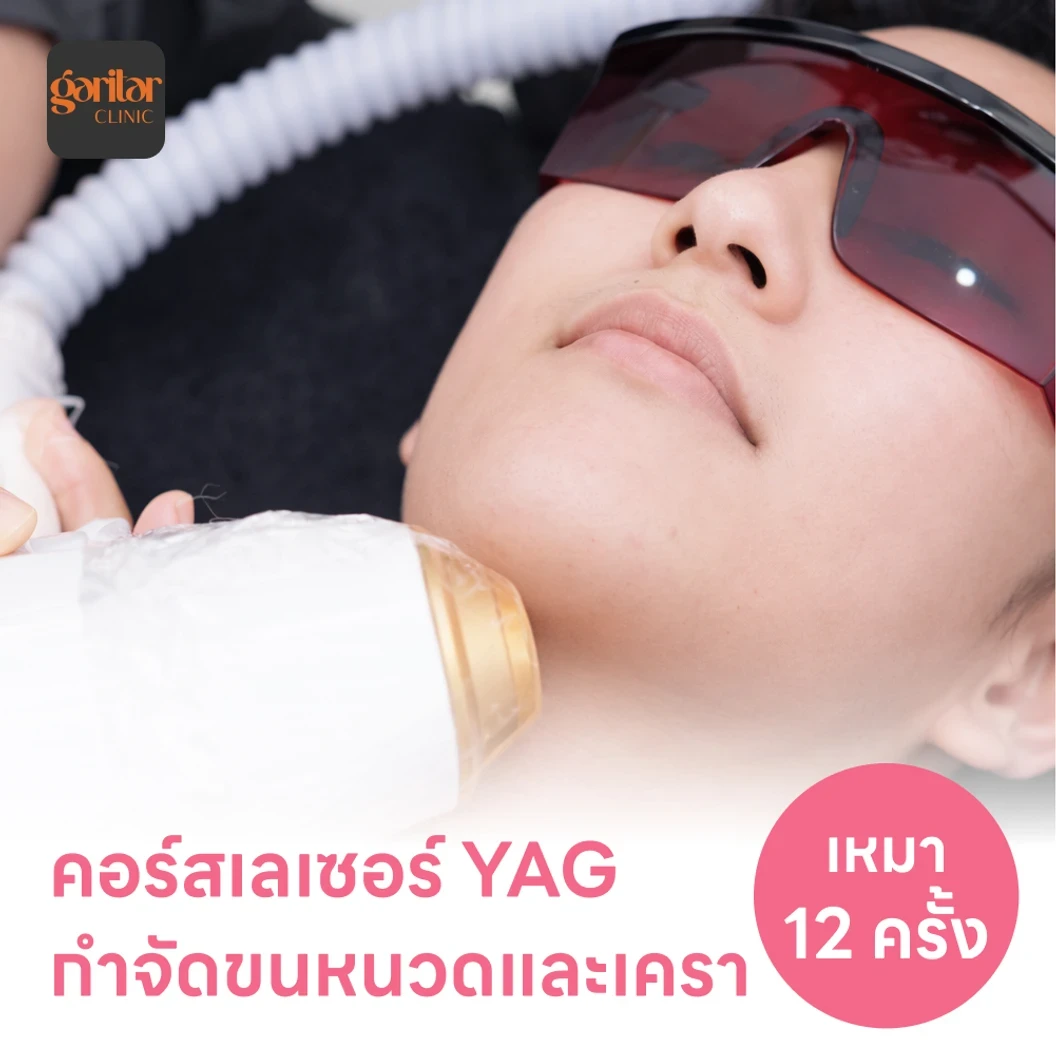 คอร์สเลเซอร์กำจัดขนหนวดและเครา 12 ครั้ง ด้วย YAG Laser