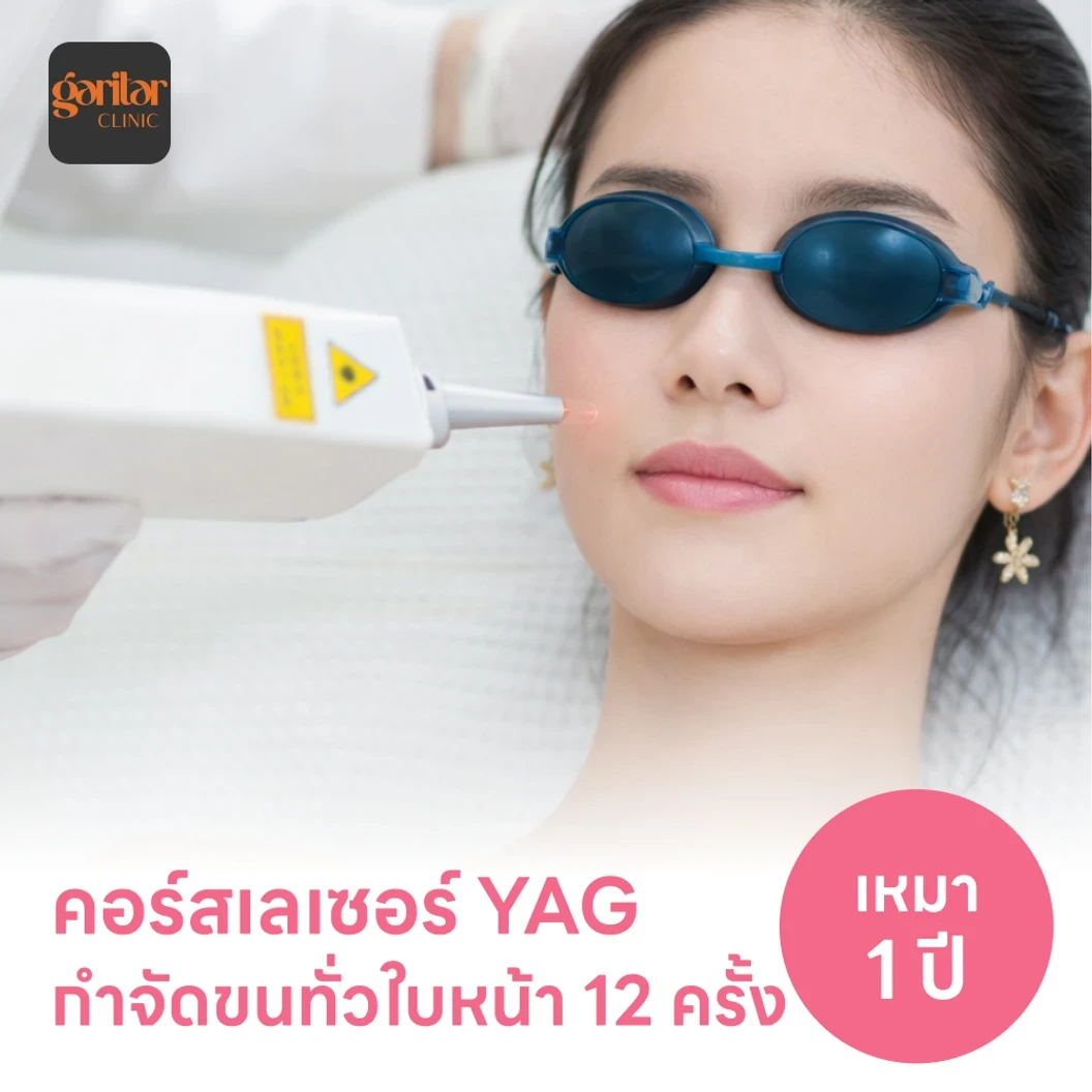 คอร์สเลเซอร์กำจัดขนทั่วหน้า 12 ครั้ง ด้วย YAG Laser