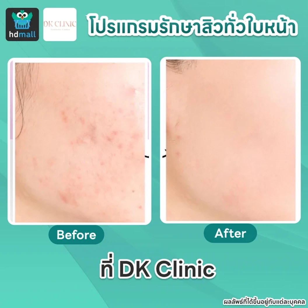 คอร์สโปรแกรมรักษาสิวทั่วใบหน้า 4 ขั้นตอน 4 ครั้ง ฟรี! 1 ครั้ง