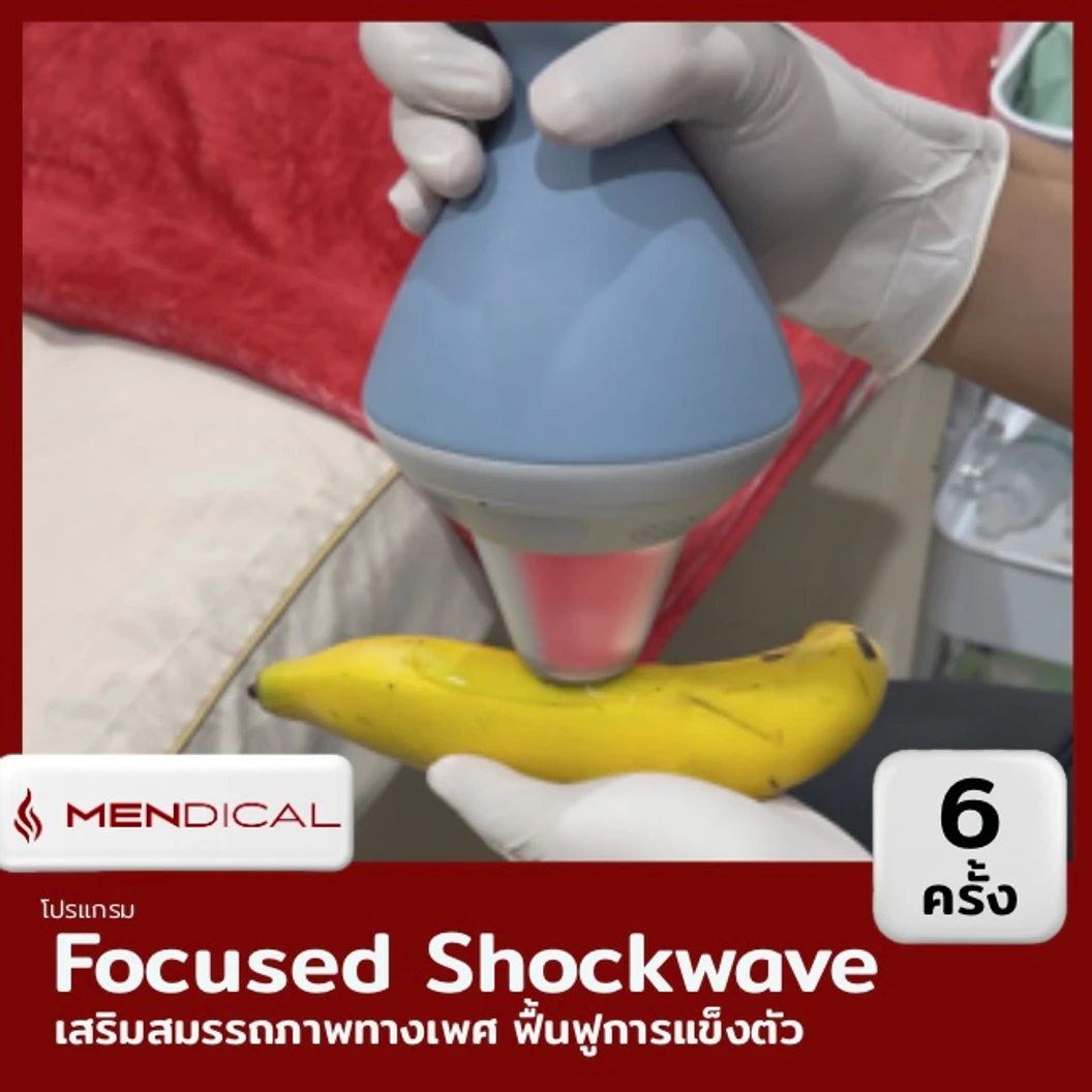 โปรแกรมเสริมสมรรถภาพทางเพศ กระตุ้นการไหลเวียนเฉพาะจุด ด้วย Focused Shockwave Therapy จำนวนช็อตขึ้นอยู่กับแพทย์ประเมิน 6 ครั้ง