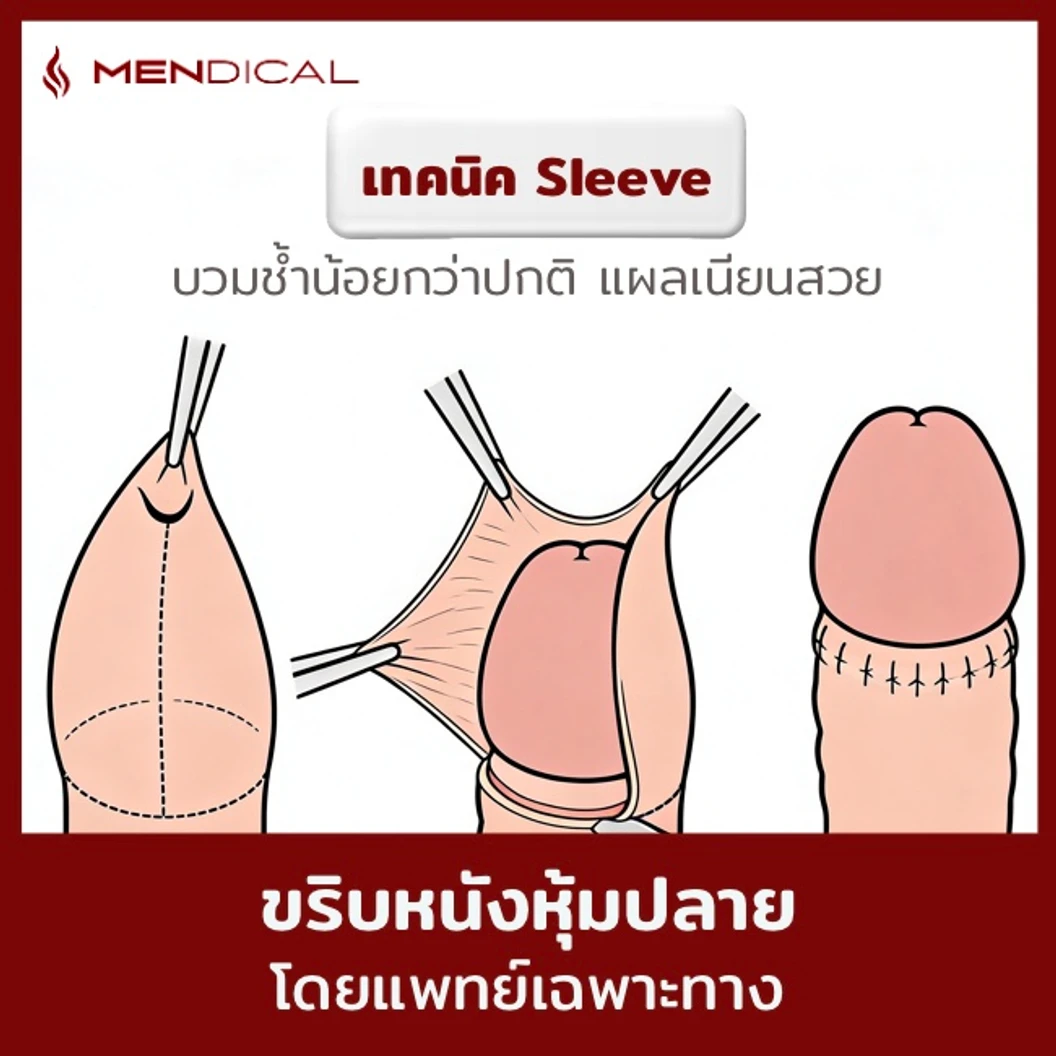 โปรแกรมขริบหนังหุ้มปลาย ด้วยเทคนิค Sleeve Technique