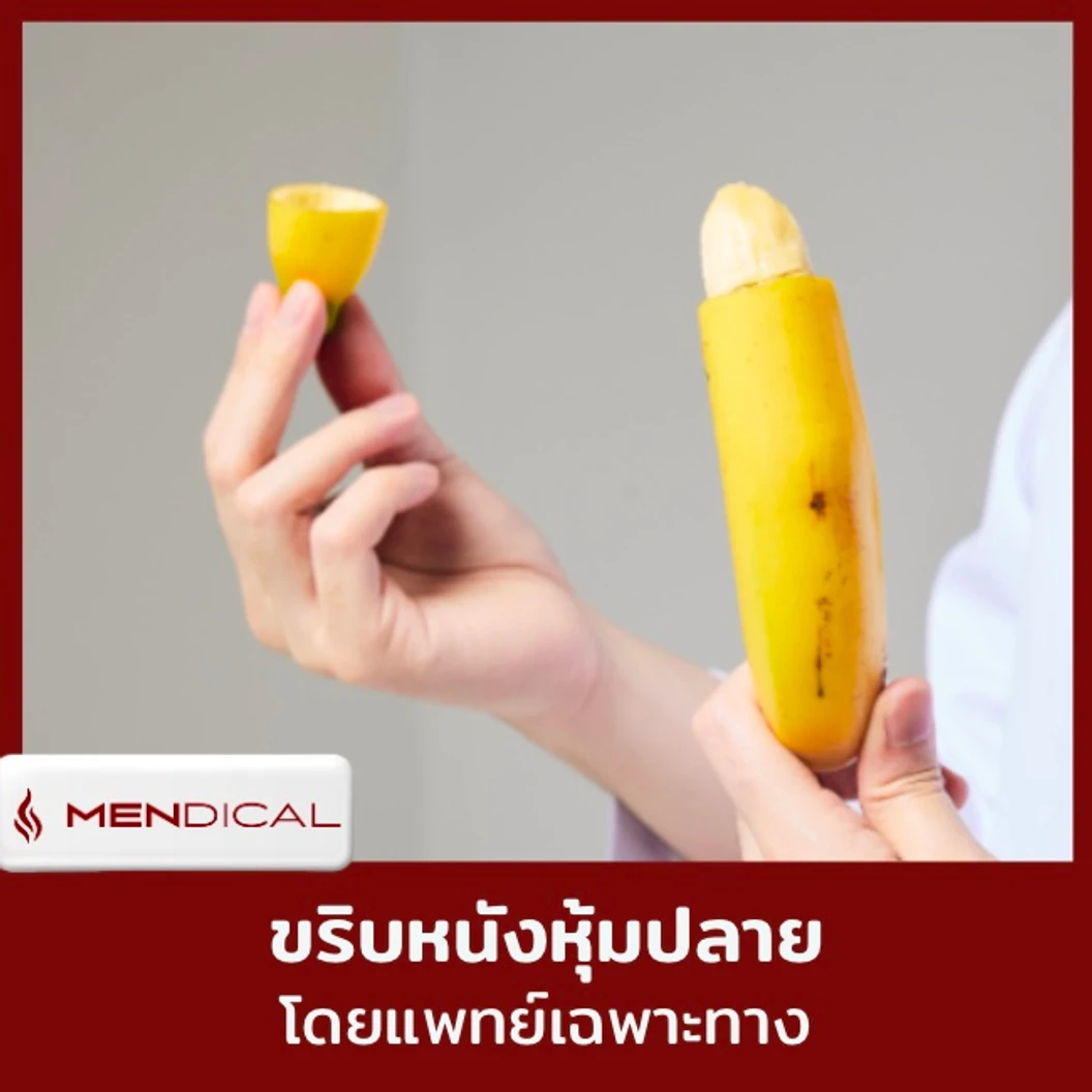 โปรแกรมขริบหนังหุ้มปลาย ด้วยเทคนิค Sleeve Technique