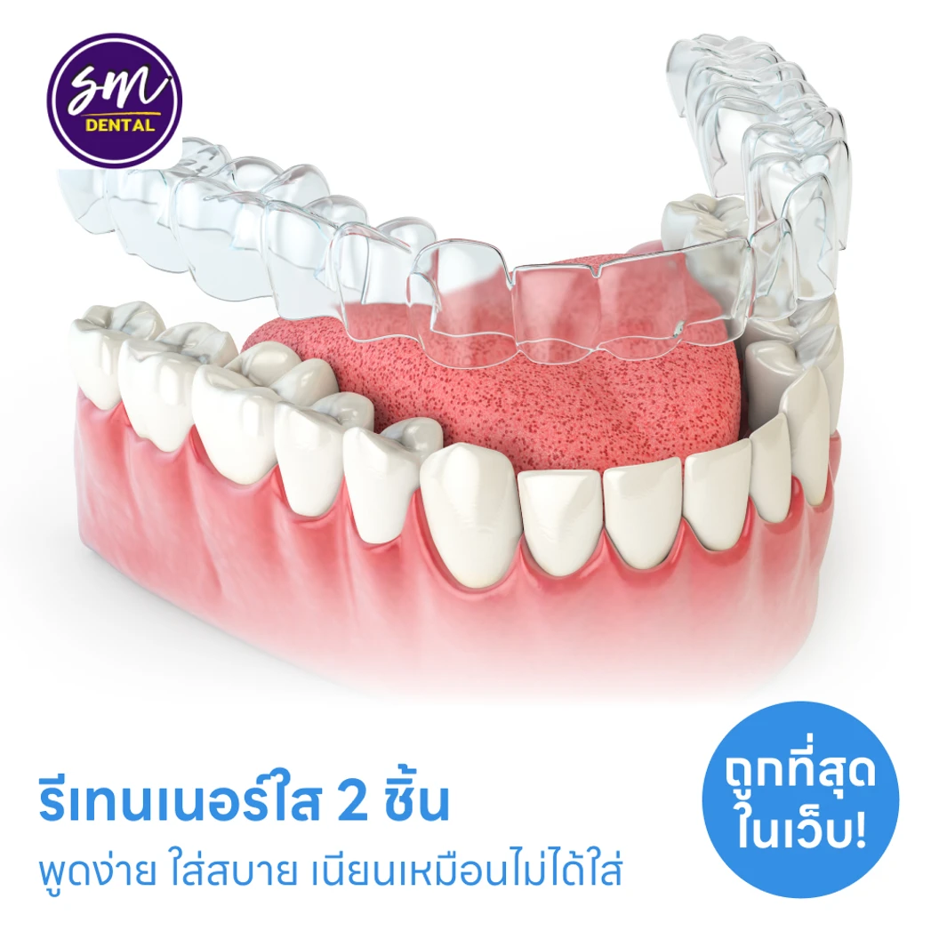 ทำรีเทนเนอร์แบบใส 2 ชิ้น