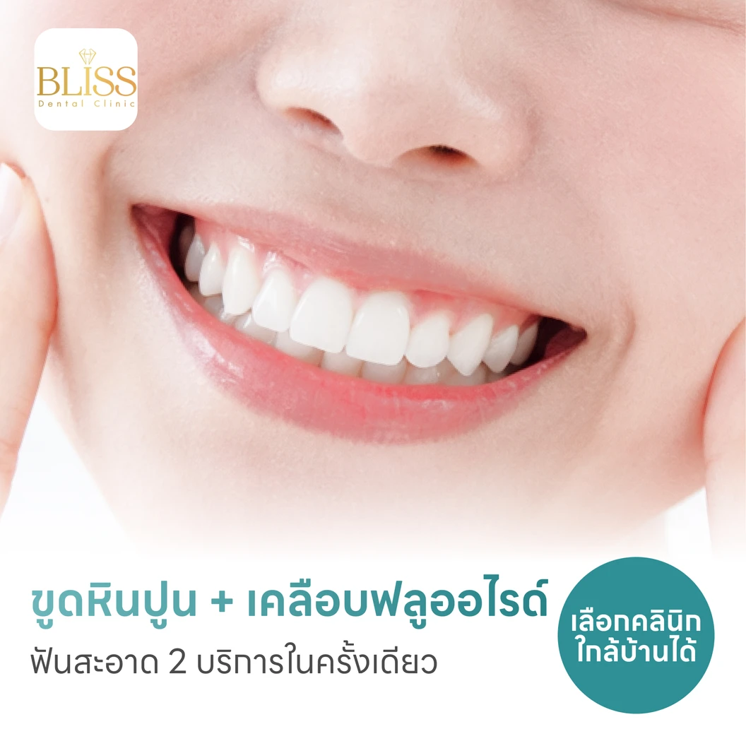 ขูดหินปูน + เคลือบฟลูออไรด์