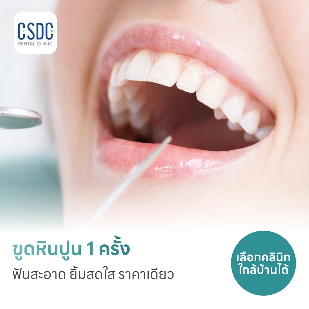 ขูดหินปูน