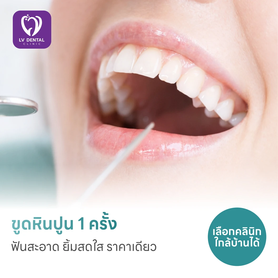 ขูดหินปูน