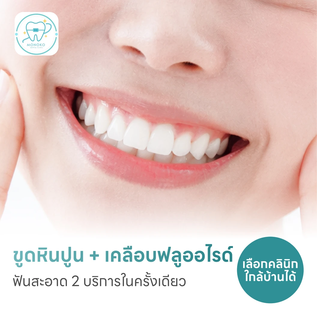 ขูดหินปูน + เคลือบฟลูออไรด์