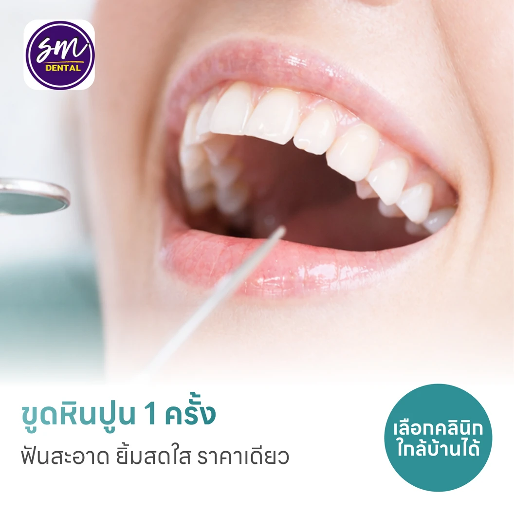 ขูดหินปูน