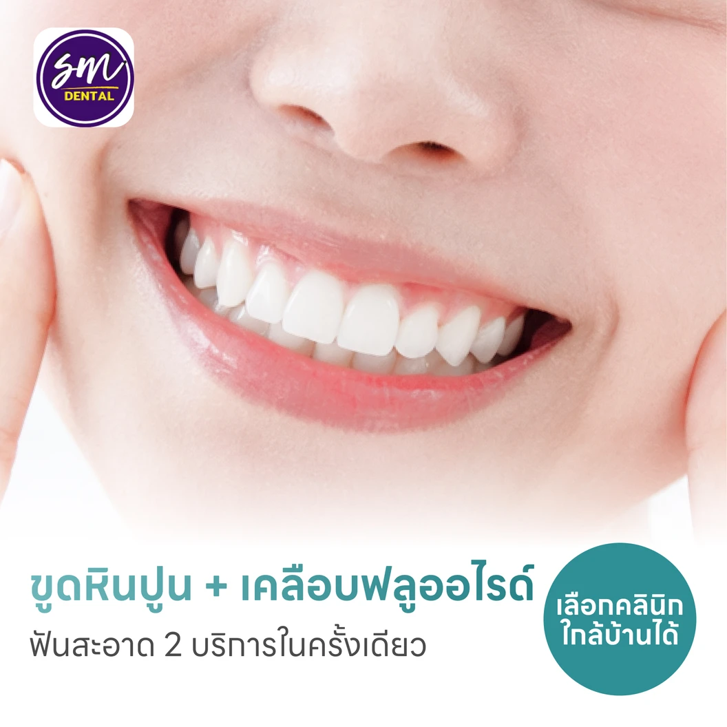 ขูดหินปูน + เคลือบฟลูออไรด์