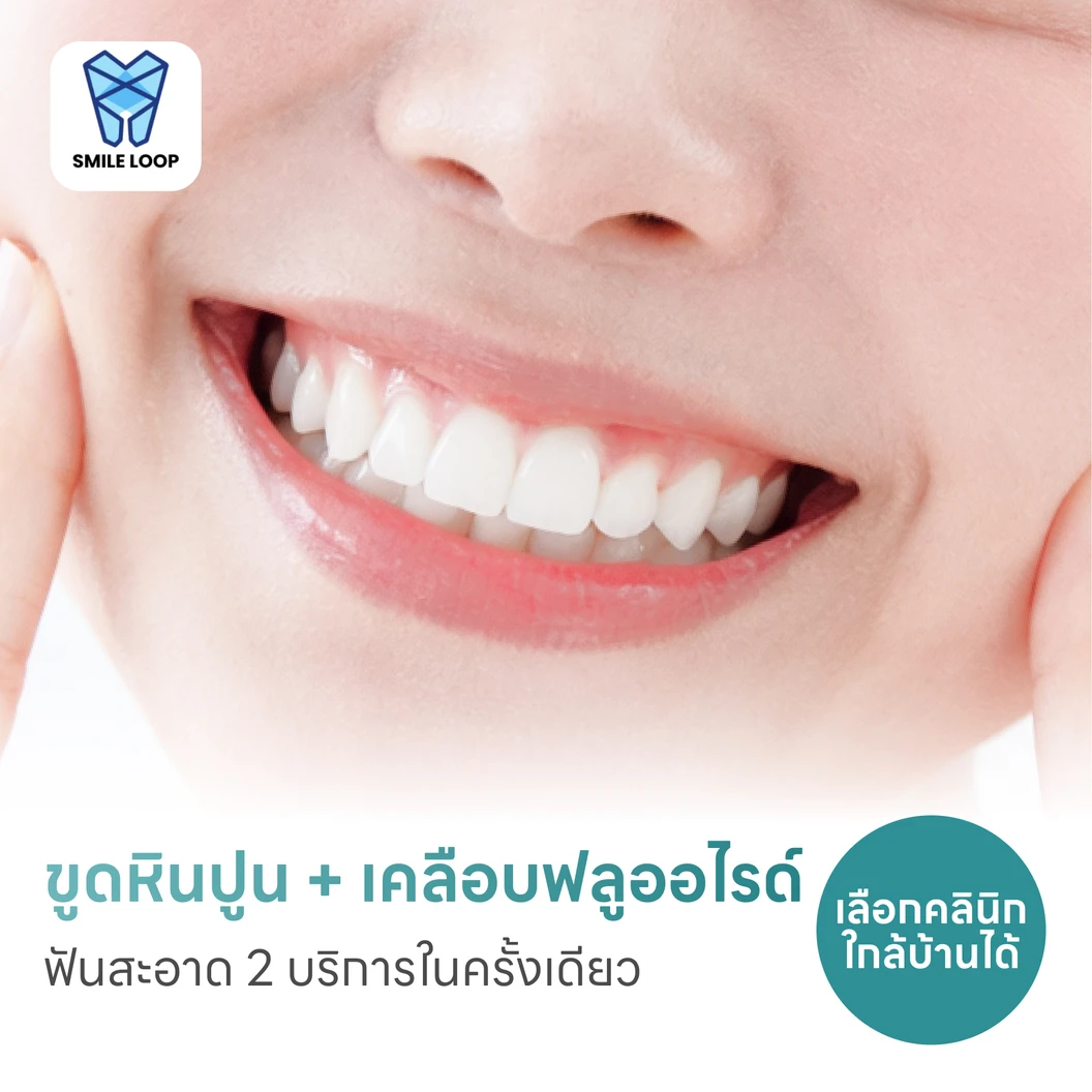 ขูดหินปูน + เคลือบฟลูออไรด์